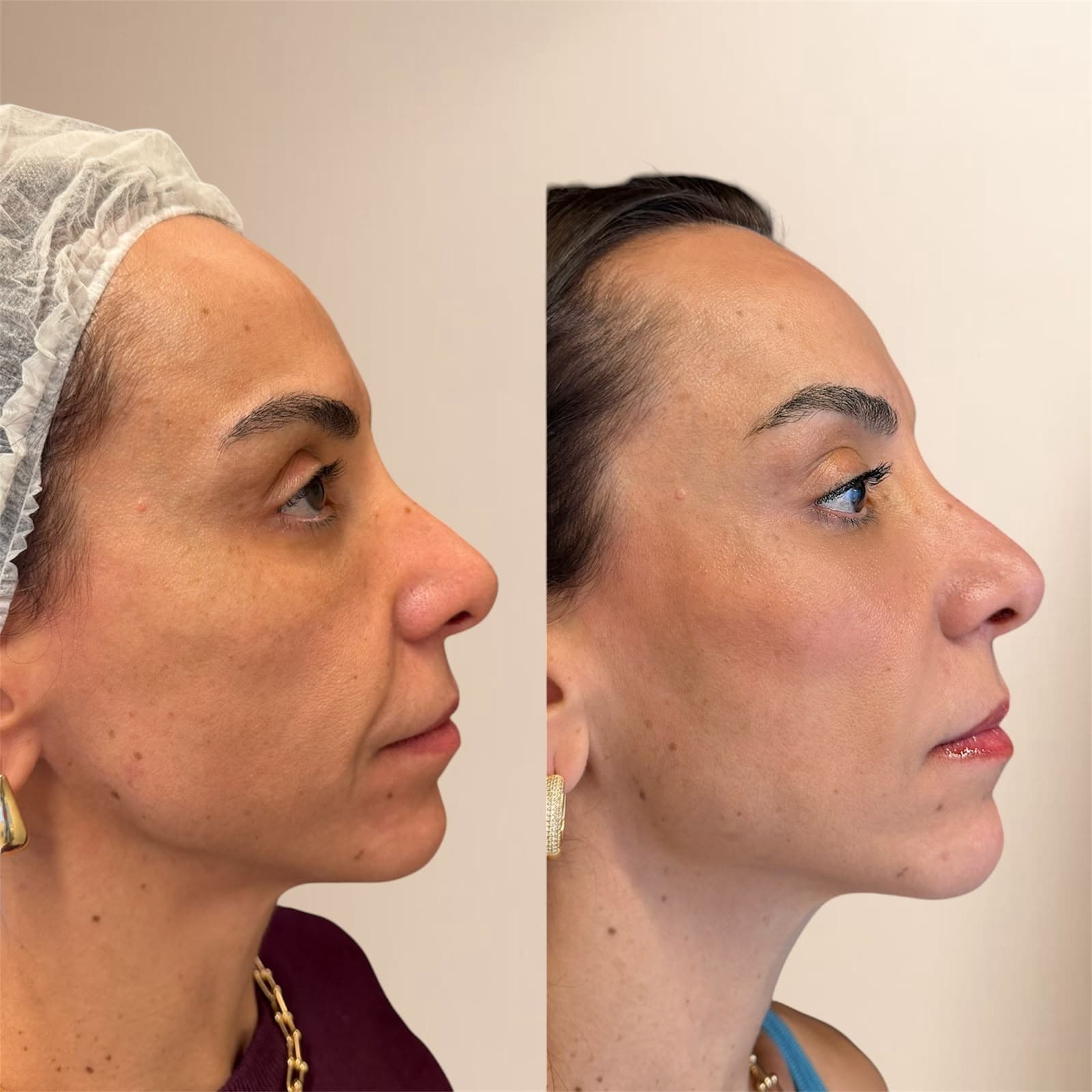 Resultado de harmonização facial Full Face na IGS Clinic