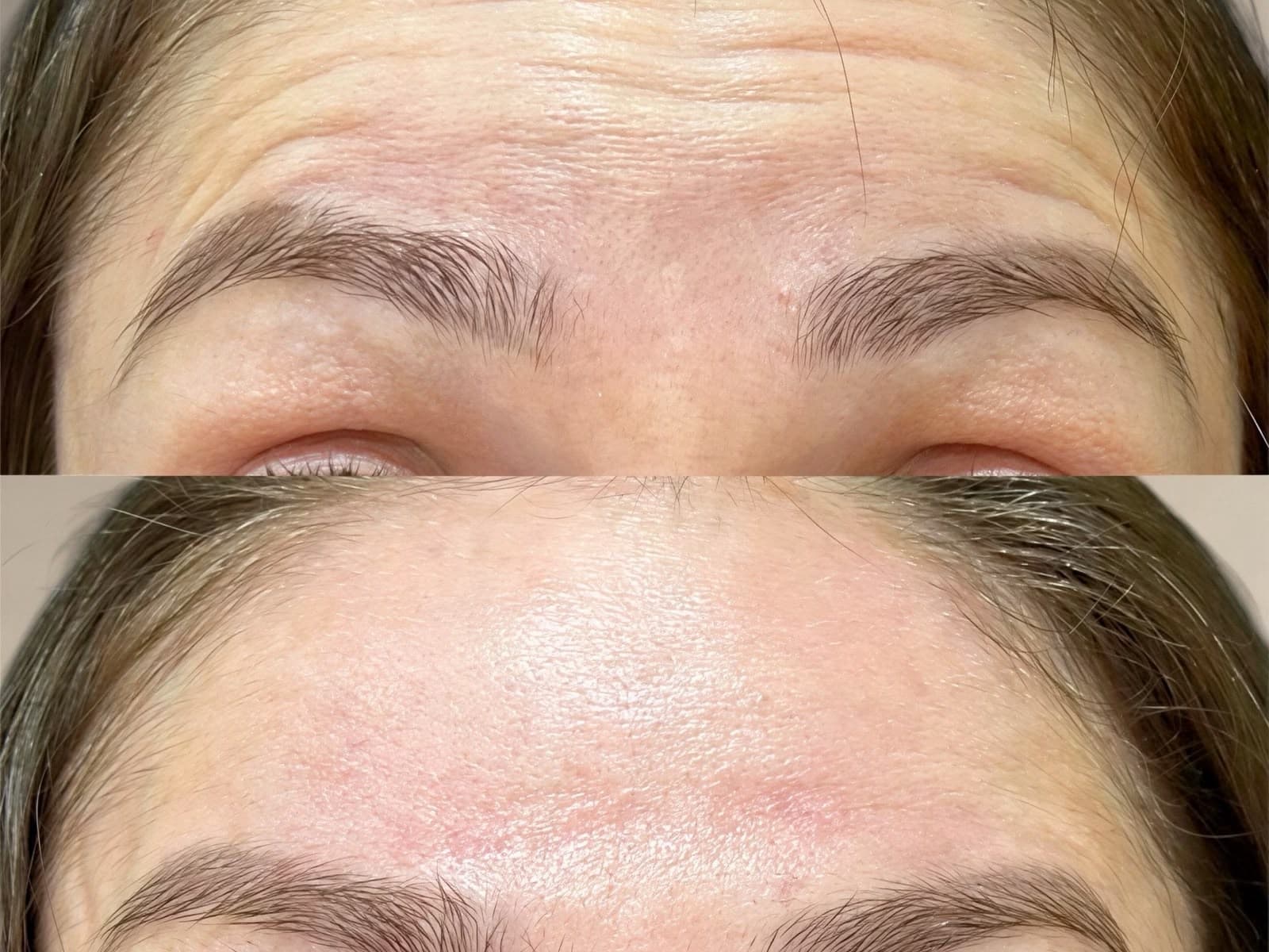 Resultado de aplicação de Botox na IGS Clinic