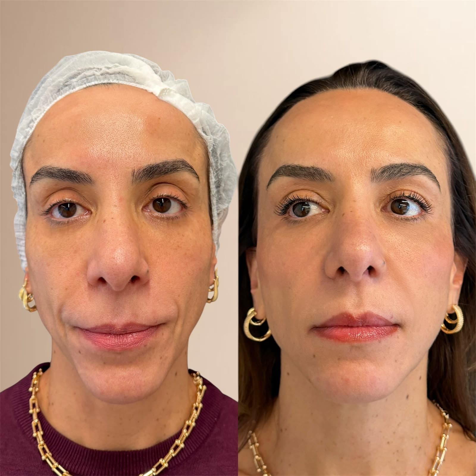 Resultado de harmonização facial Full Face na IGS Clinic