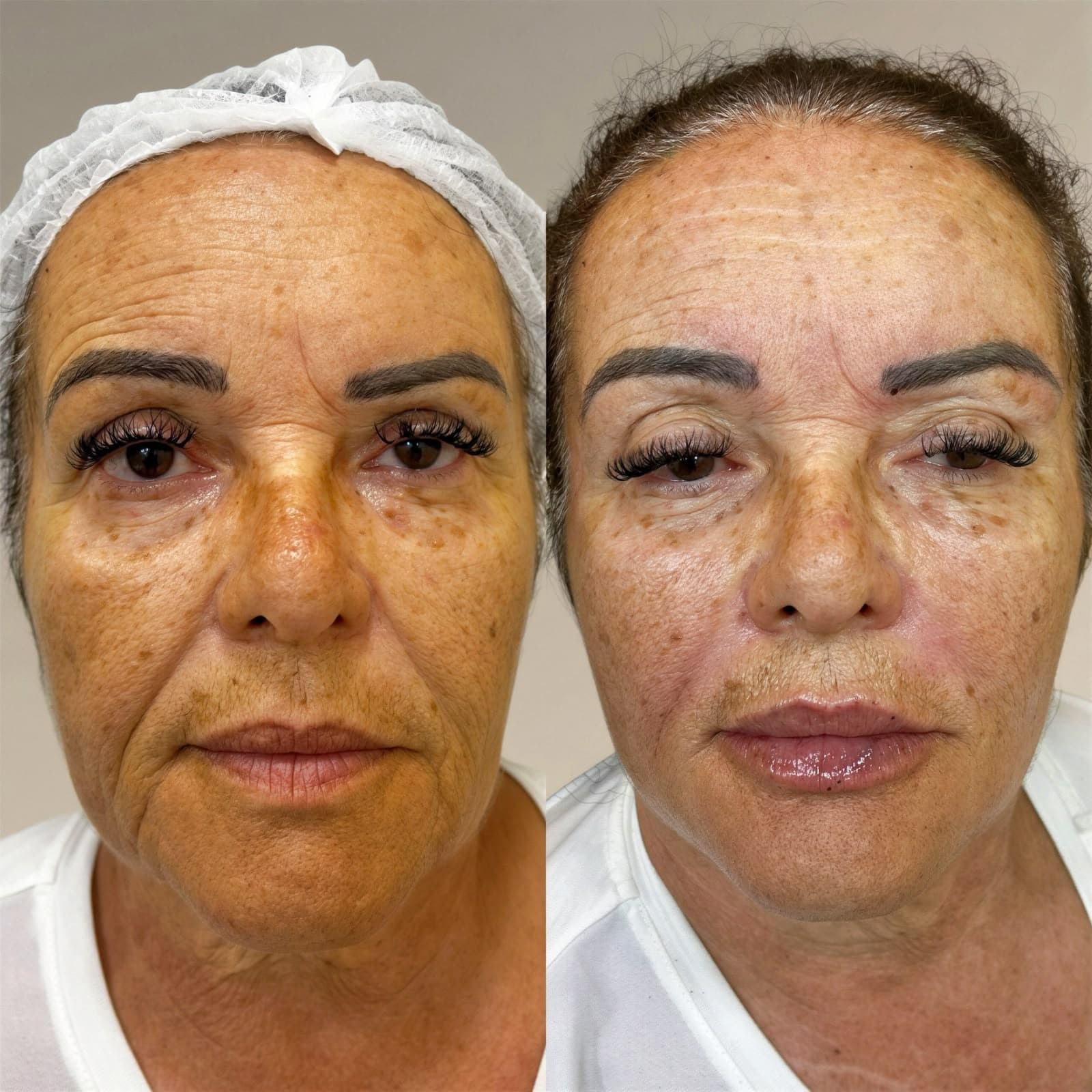 Resultado de harmonização facial Full Face na IGS Clinic